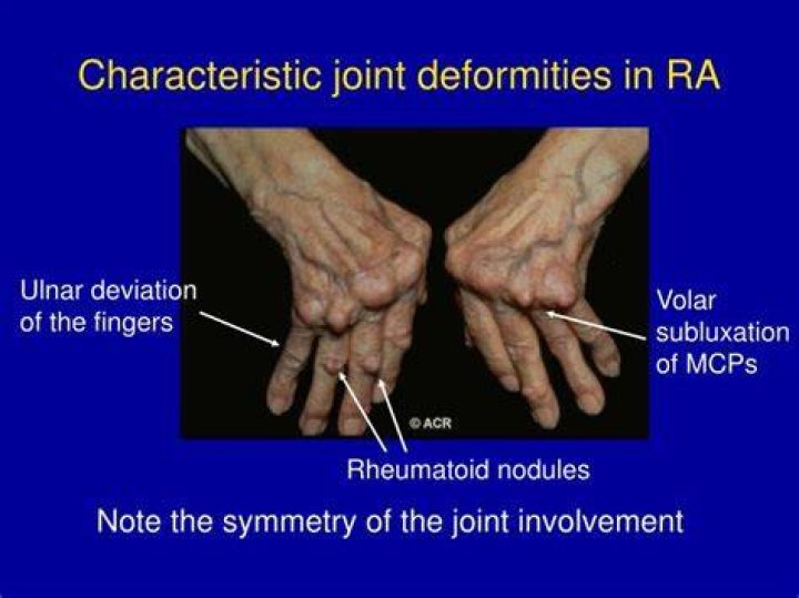 What causes joint deformity in rheumatoid arthritis