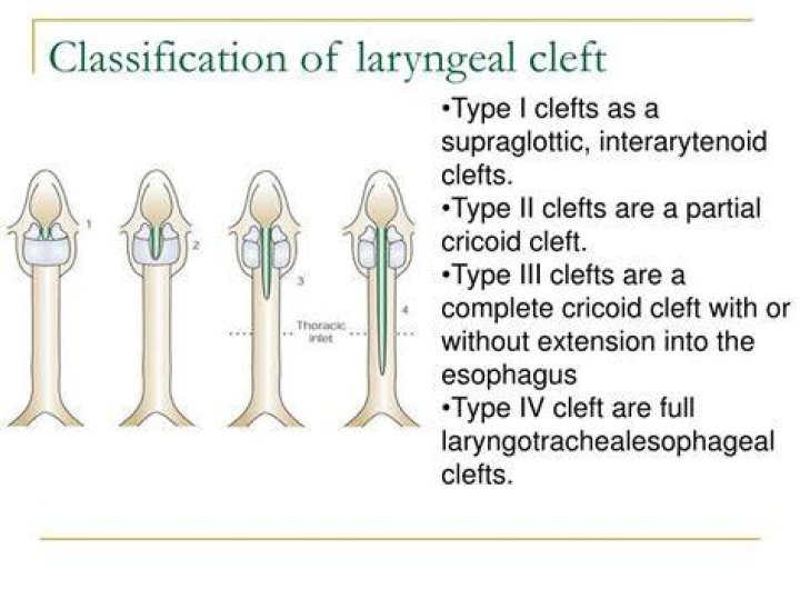 What causes laryngeal cleft