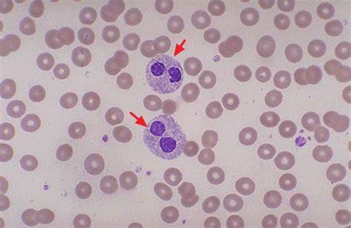 What causes pelger Huet anomaly