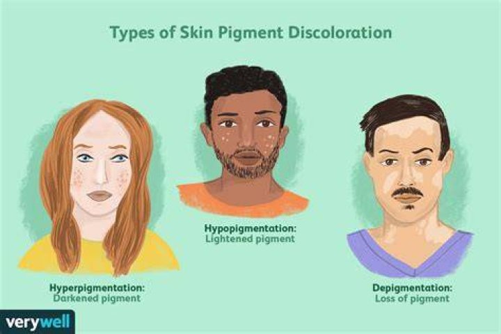 What causes Pheomelanin