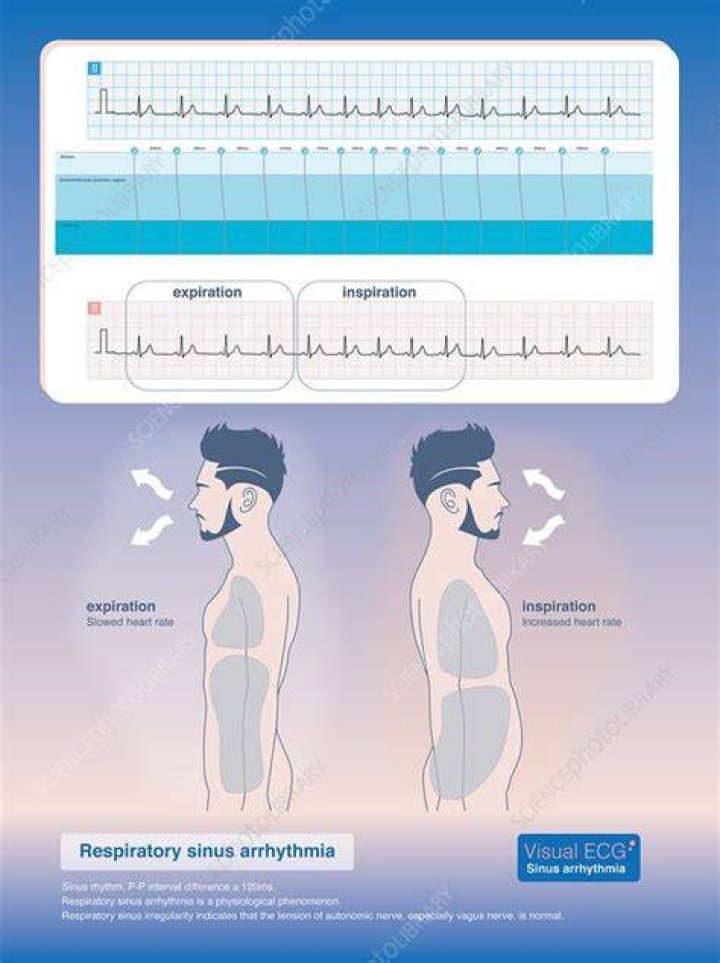What causes respiratory sinus arrhythmia