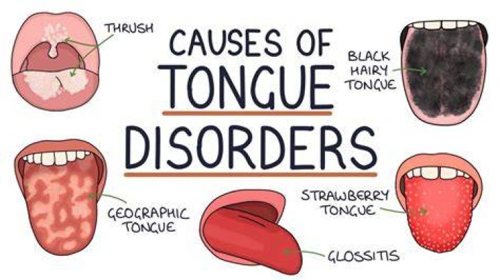 What causes tongue paralysis