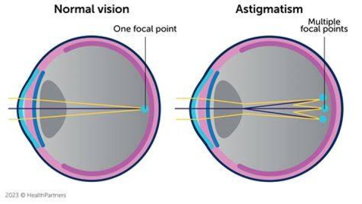What do you call a person with astigmatism