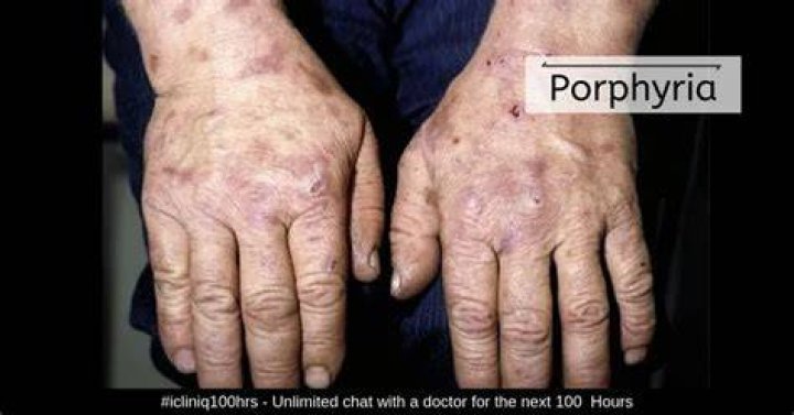 What does a porphyria attack feel like