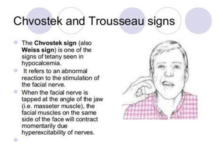 What does a positive chvosteks sign indicate