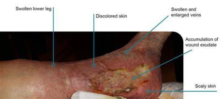 What does a venous stasis ulcer look like