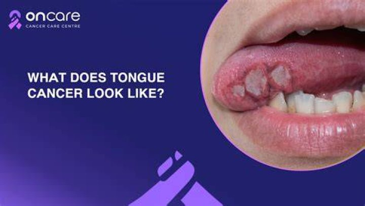 What does cancer under tongue look like