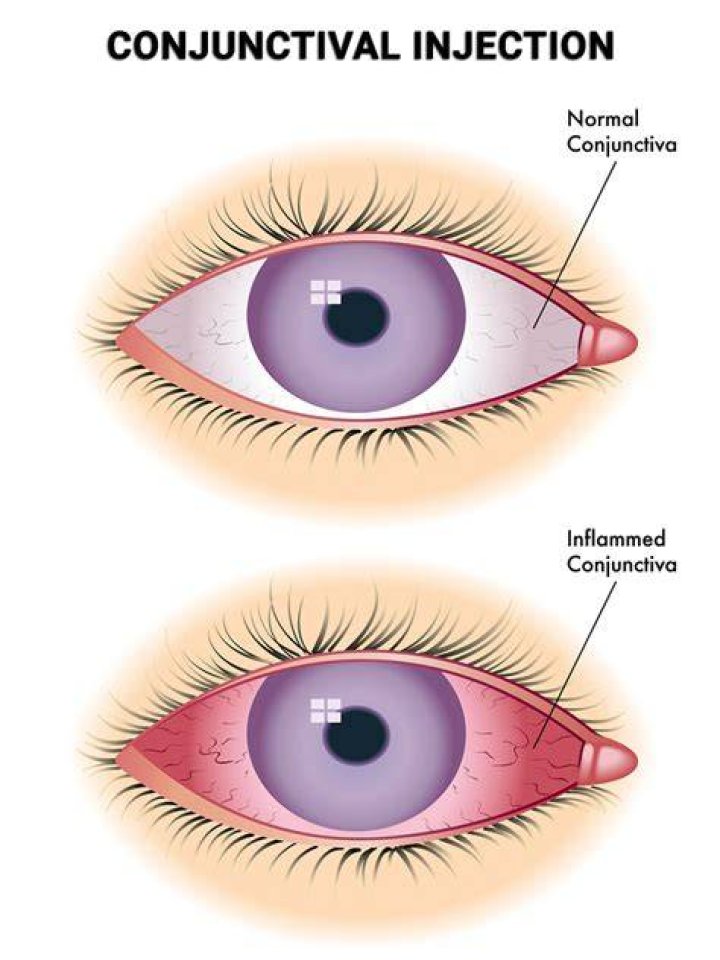 What does conjunctival injection mean