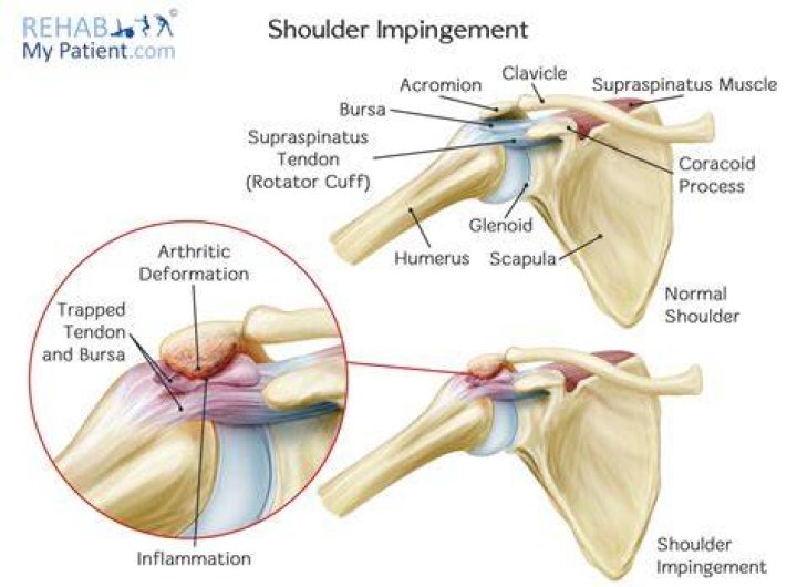 What does impingement mean
