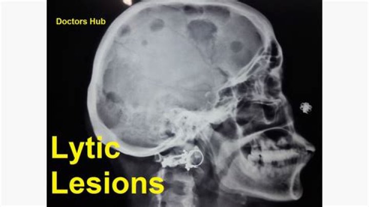 What does lesions on the skull mean