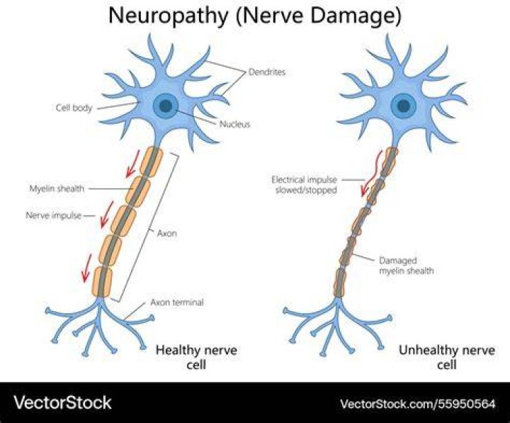 What does nerve damage look like