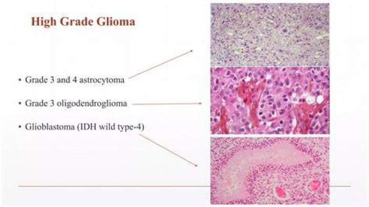 What is a high grade glioma