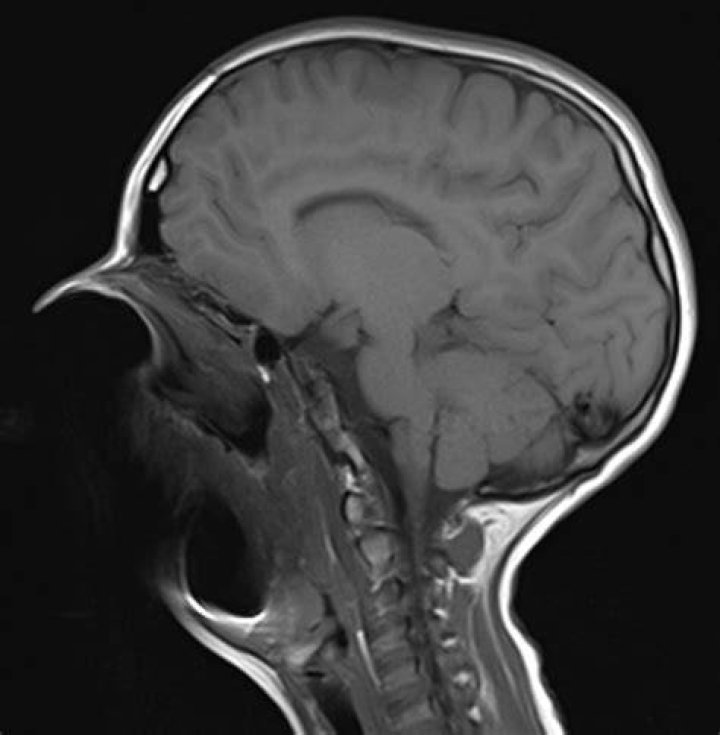 What is a susceptibility artifact