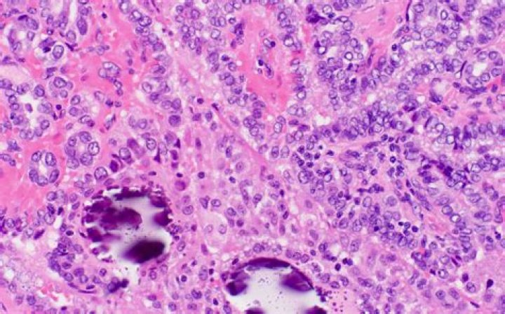 What is an orphan cancer