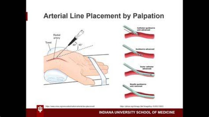 What is arterial line placement
