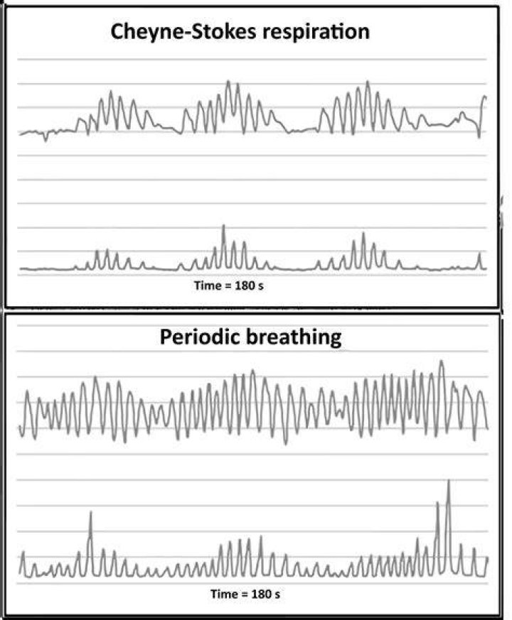 What is Cheyne Stokes breathing pattern