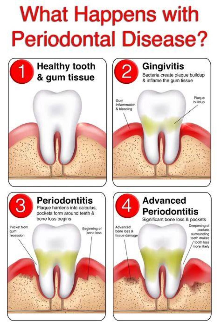 What is chronic periodontal gum disease