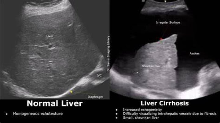 What is coarse hepatic Echotexture