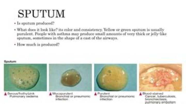 What is copious sputum production