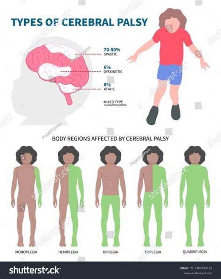 What is Diplegia in cerebral palsy