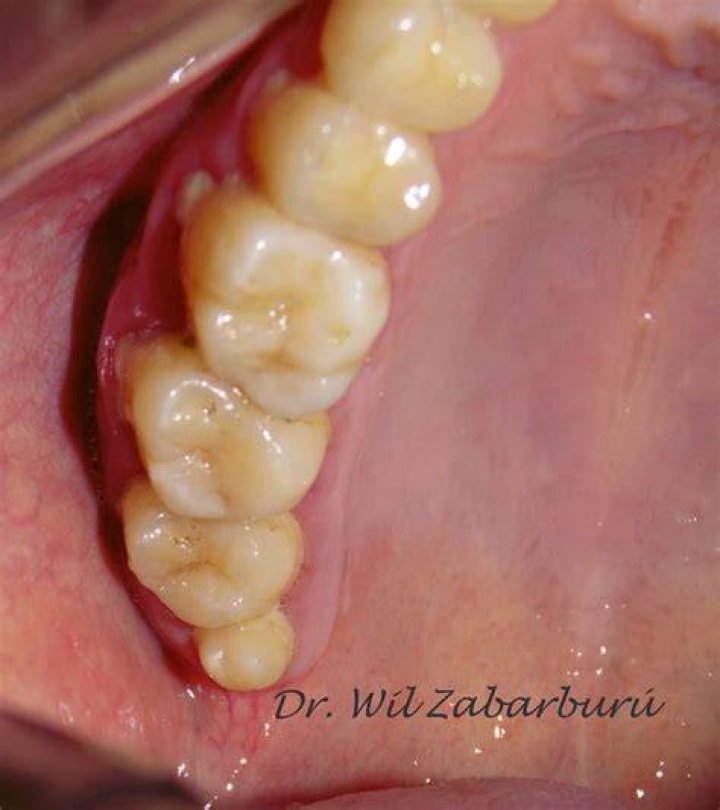 What is Distomolar