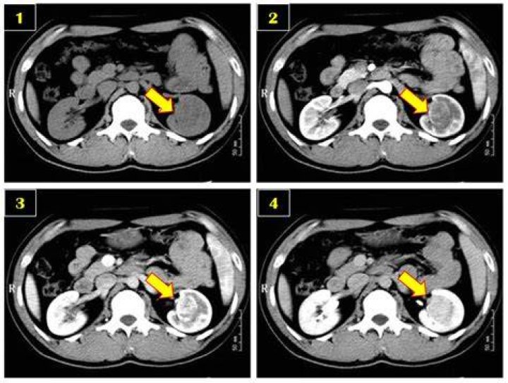 What is double contrast CT scan