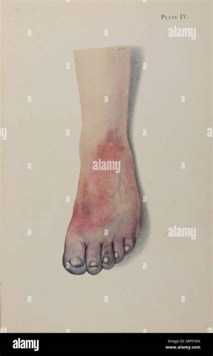 What is gas gangrene ww1