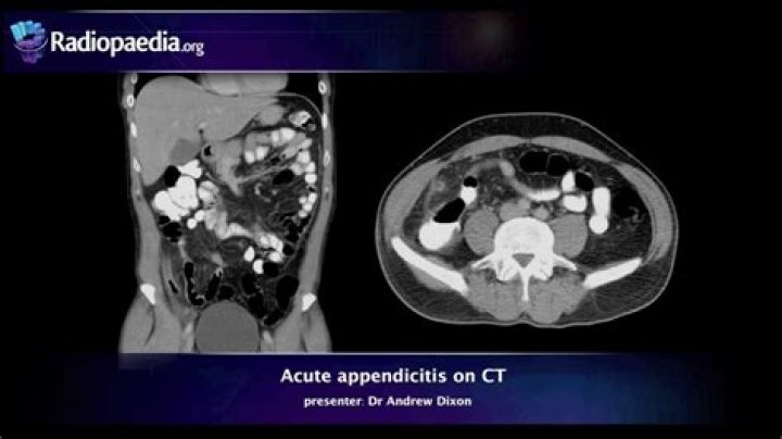 What is imaging for appendicitis