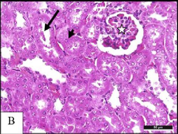 What is kidney debris