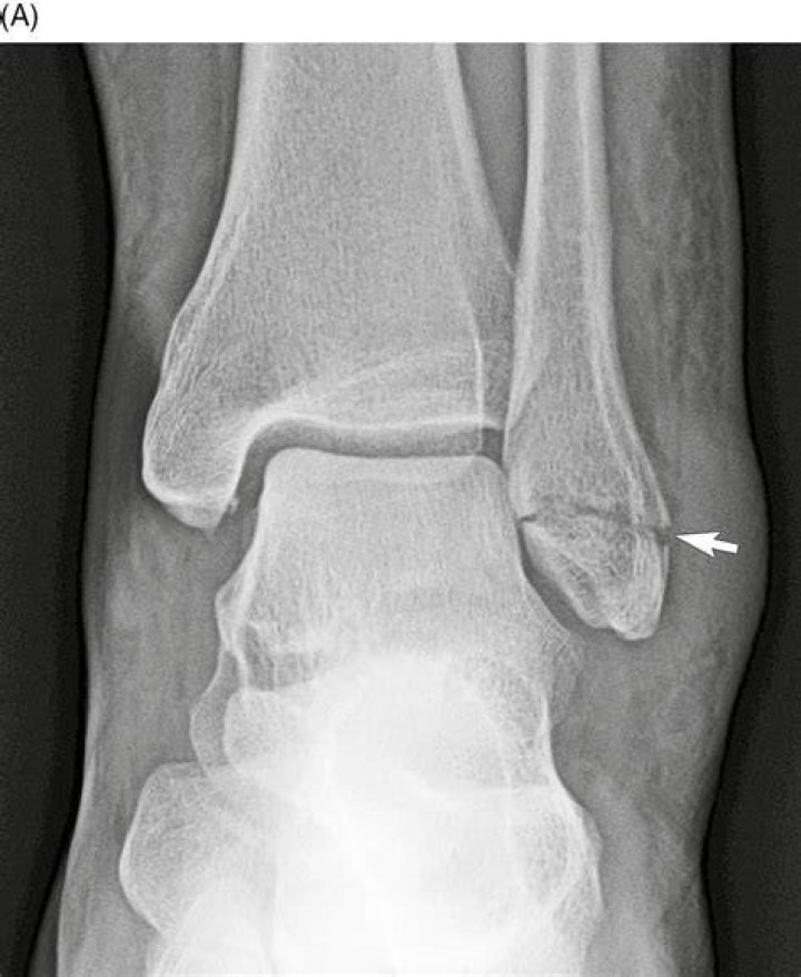 What is lateral malleolus fracture