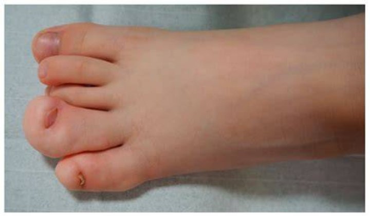 What is Macrodactyly of the foot