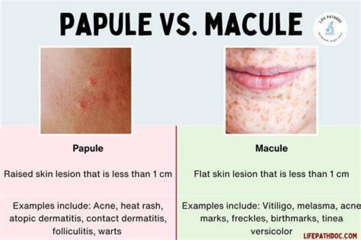What is Macule and Papule