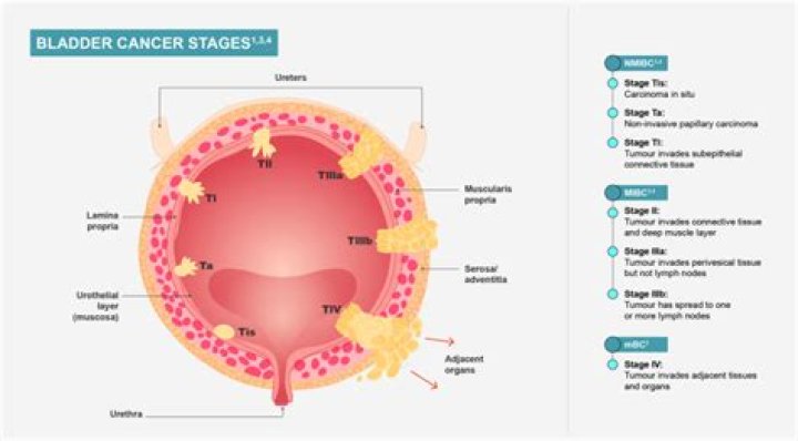What is muscle invasive bladder cancer