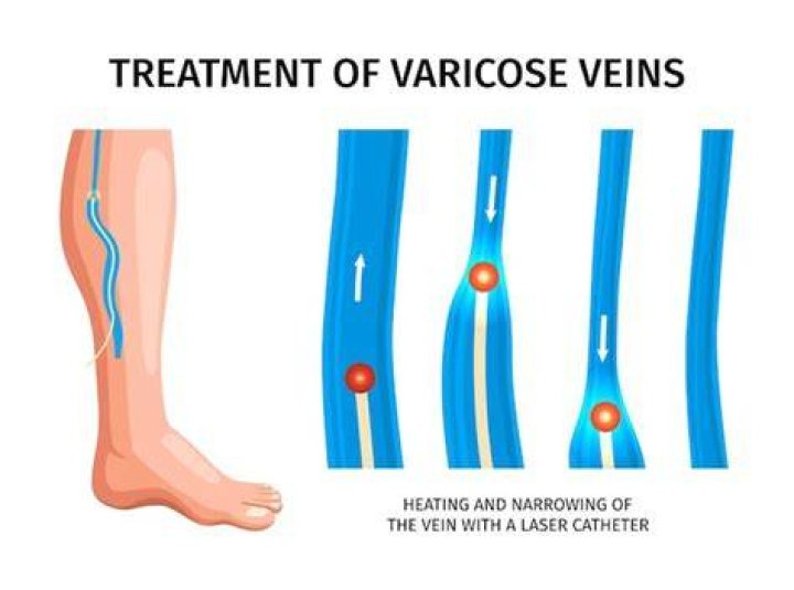 What is narrowing of the veins called