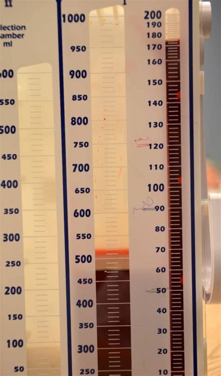 What is normal chest tube drainage amount