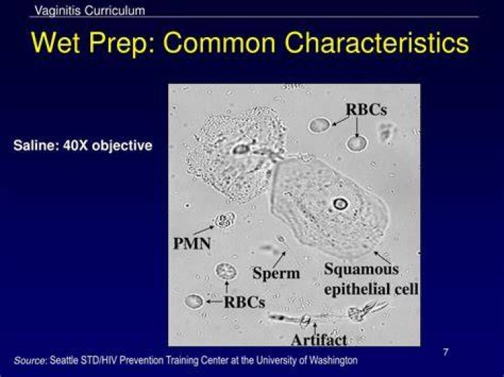 What is PMN on wet prep