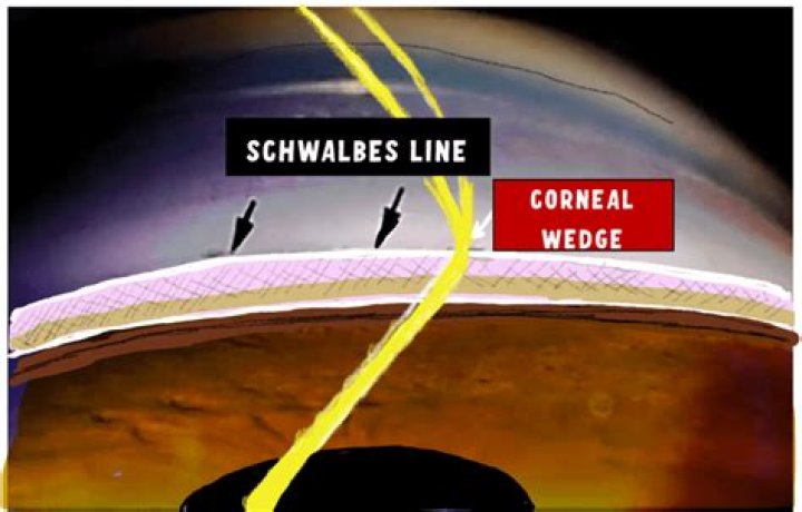What is Schwalbes line