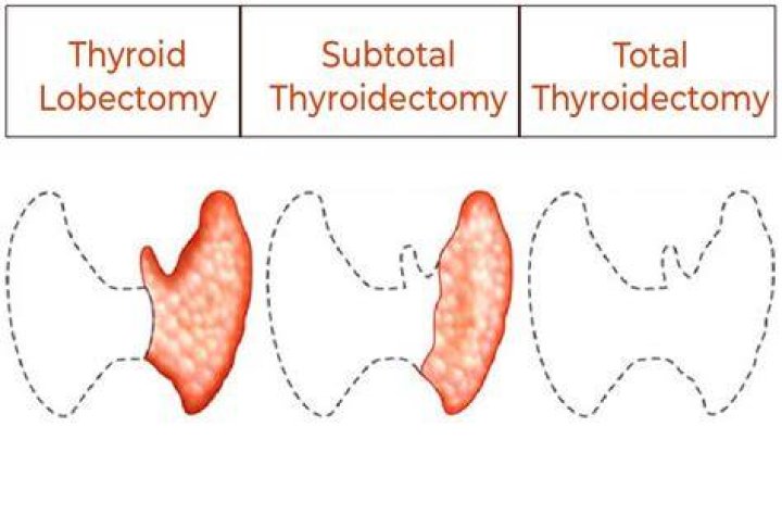 What is subtotal thyroidectomy