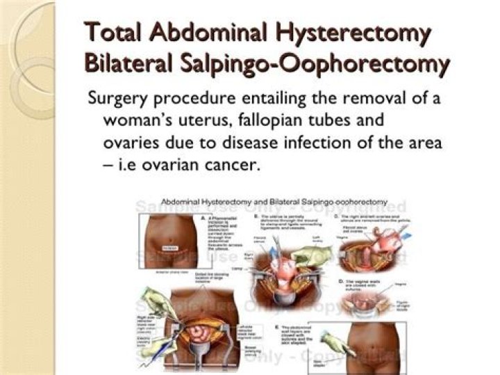 What is the root operation for bilateral salpingo oophorectomy