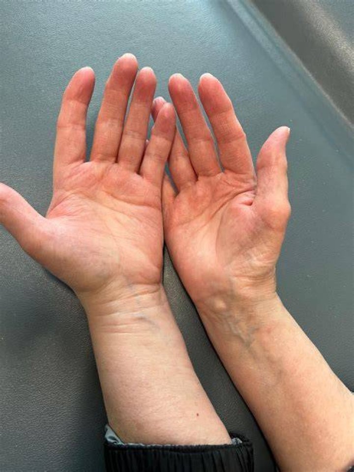 What is thenar muscle atrophy
