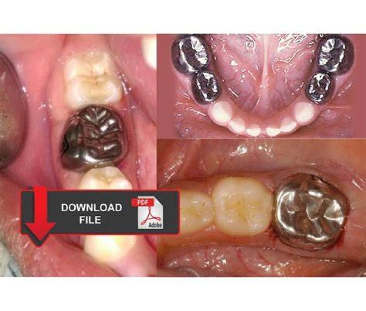 What metals are in stainless steel crowns