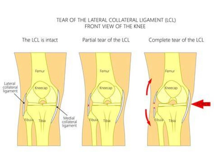 What movement does the lateral collateral ligament prevent