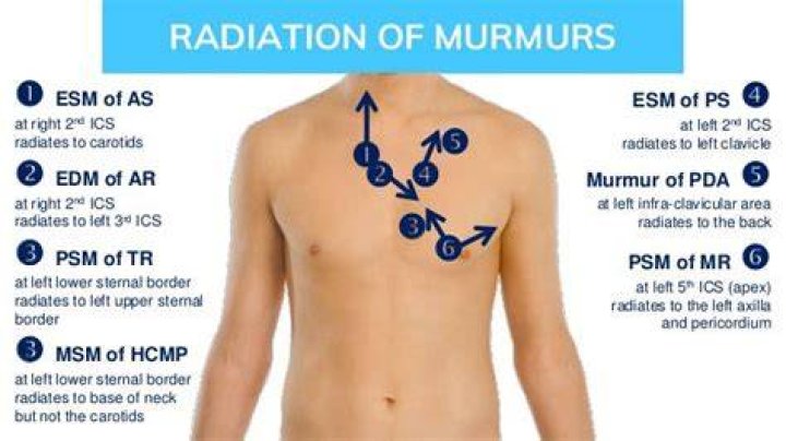 What murmur radiates to the back