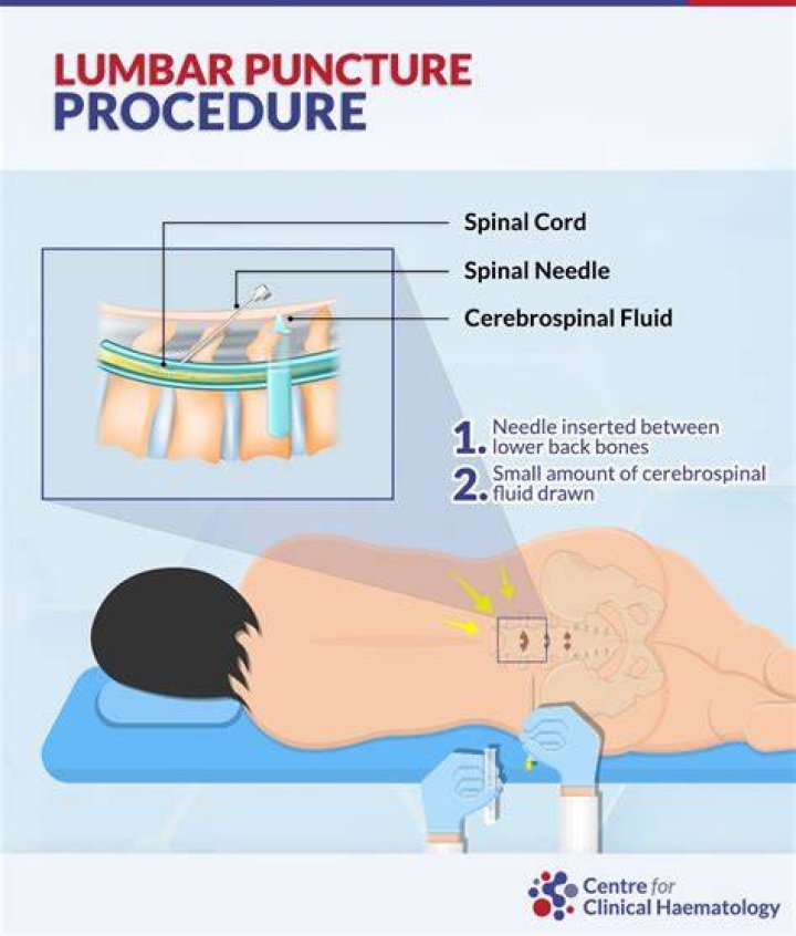 What should I do to prepare for a lumbar puncture