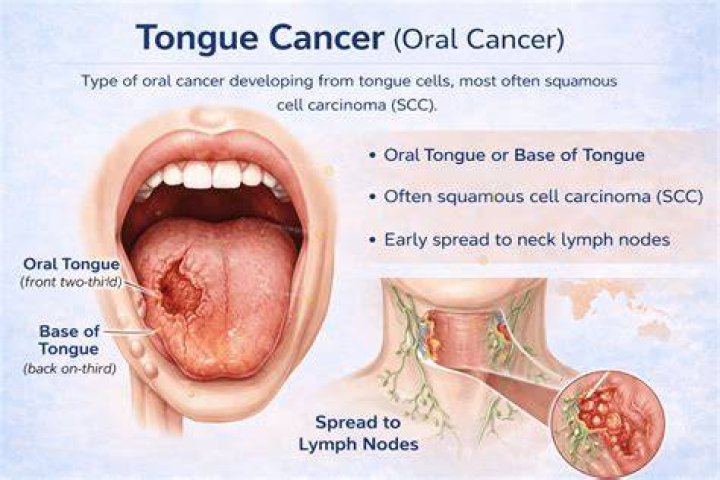 Where does base of tongue cancer spread