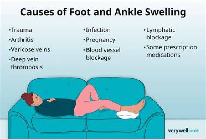 Why are my ankles swollen after flying