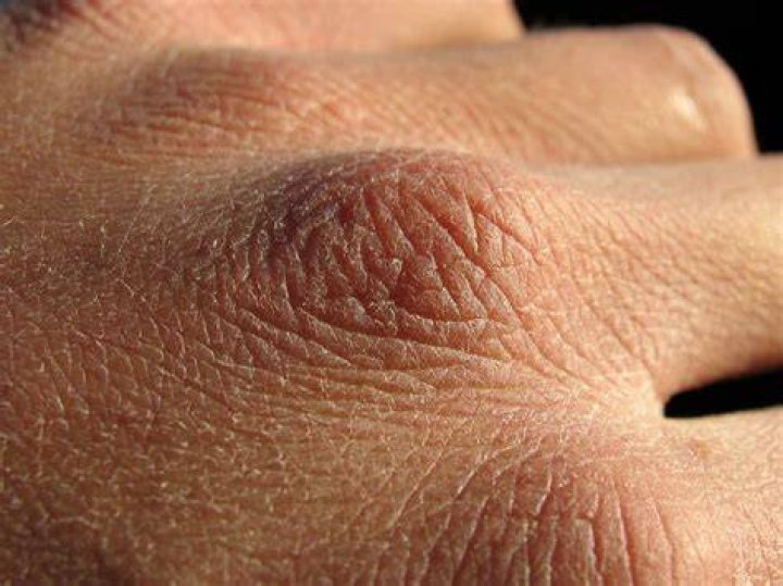 Why do my hands get dry and cracked