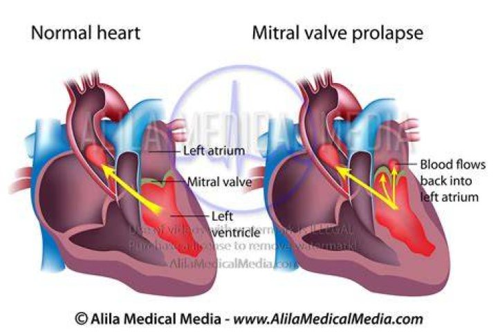 Why does mitral valve prolapse murmur increases with Valsalva