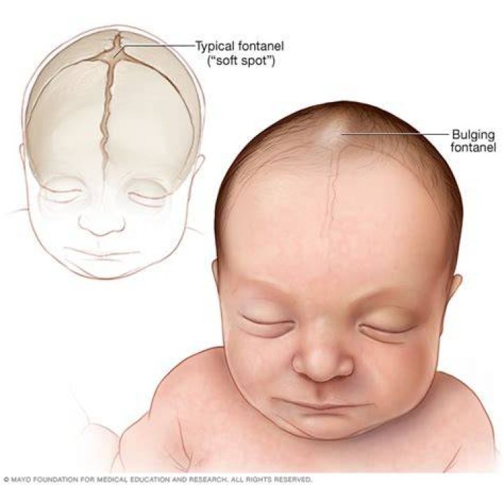 Why is my babys Fontanel sunken